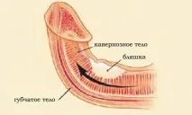 болестта пейрони