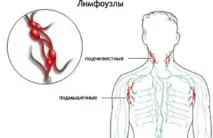 диагностика лимфаденит