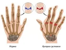 пръстите лечение