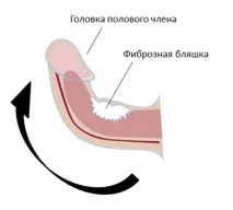 лечение пейрони