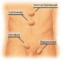 Лікування грижі передньої черевної стінки - Лазерний медичний центр грижі