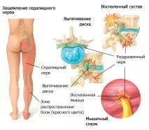 прищипване седалищния нерв