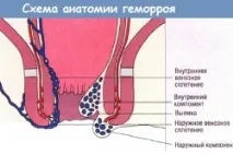 хемороиди хемороиди