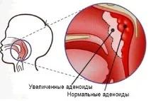 Мигдалики в горлі їх значення, розташування та функції горлі