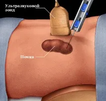 Біопсія нирки як виконується, вартість та наслідки наслідки