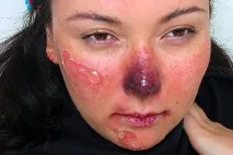 признаци симптоми