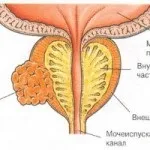 лечение онкоурологично