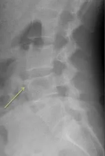 Персистуючий апофіз (Limbus vertebrae) limbus