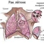 пневмонія
