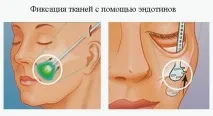 Пластика вилиць на будь-який смак 5 методів, щоб поліпшити обриси овалу смак