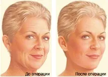 лицето повдигане