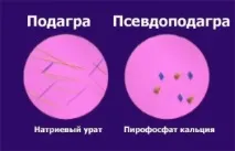 Псевдоподагра - причини розвитку, симптоми та лікування захворювання розвитку