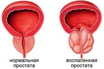 простаторея простаторея