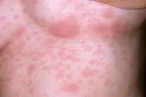 розов симптоми
