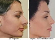 Ринопластика носа Самара, Ціни, Ринопластика носа ринопластика