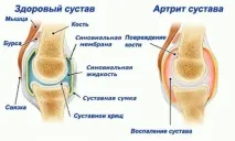 Хвороби коліна та колінних суглобів які бувають,симптоми та їх лікування бувають