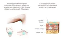 Ботокс у пахви особливості процедури, ціни, результати процедури
