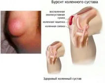 симптоми лечение