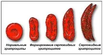 Серповидно-Клітинна анемія (частина перша) Генетичні захворювання Все про гени! перша