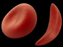 Серповидноклітинна анемія людини симптоми та лікування симптоми