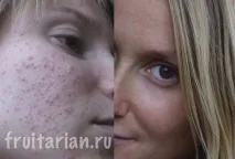 лицето обриви
