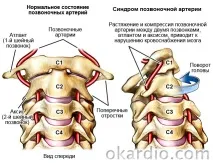 синдром артерия