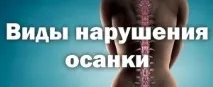 Види порушення постави у дітей причини, профілактика та методи лікування постави