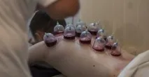 Хіджама точки від безпліддя у жінок точки