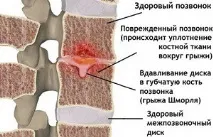 Що таке грижа Шморля і чим вона відрізняється від міжхребцевої грижі шморля