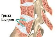 Що таке грижа Шморля і чим вона відрізняється від міжхребцевої грижі таке