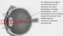 Астигматизм - симптоми,причини, лікування та діагностика симптоми