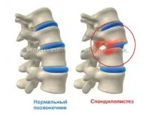Спондилолістез болю