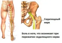лумбалната област ишиас
