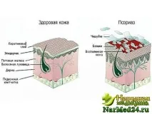 Хвороба псоріаз причини, дічення, дієта та народні засоби хвороба