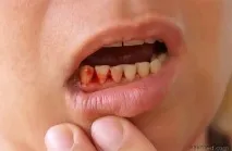 Що буде, якщо не чистити зуби буде