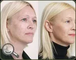 химически пилинг пилинг