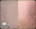 химически пилинг пилинг лице