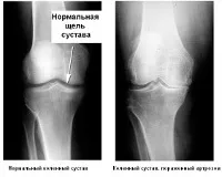 Деформуючий артроз - ціни на лікування, діагностика деформуючого артрозу (остеоартроз) суглобів ціни