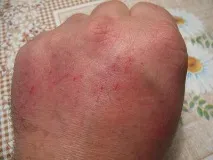 пъпки ръцете