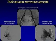 Емболізація маткових артерій, як альтернатива хірургічному втручанню маткових