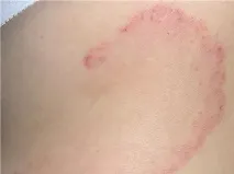 еритема ухапване кърлеж