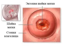 Ектопія шийки матки - причини, симптоми та лікування симптоми
