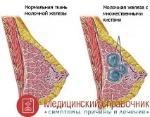 Фіброзно-кістозна мастопатія - симптоми, лікування, ознаки, фото мастопатія
