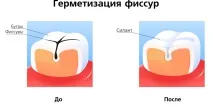 Герметизація фісур постійних та молочних зубів молочних