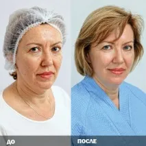подмладяване фракционно