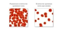 Головний біль при місячних причинах, лікування причинах