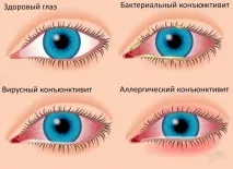 Очні краплі від алергії, назви краплі