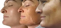 пилинг химически