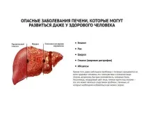 увайдов предпазим