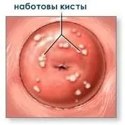 Кіста шийки матки походження захворювання, методи лікування, народна медицина походження